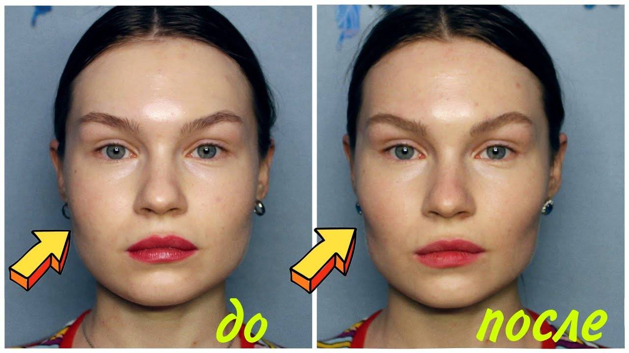 3d моделирование лица: как сделать "худое лицо" филлерами