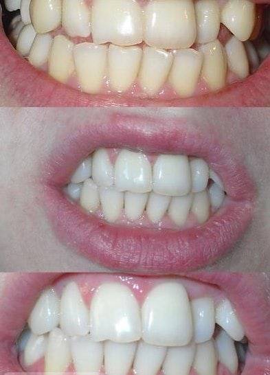 Отбеливание зубов маслом, деликатное осветление эмали
