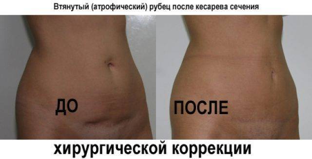 Возможные осложнения после маммопластики