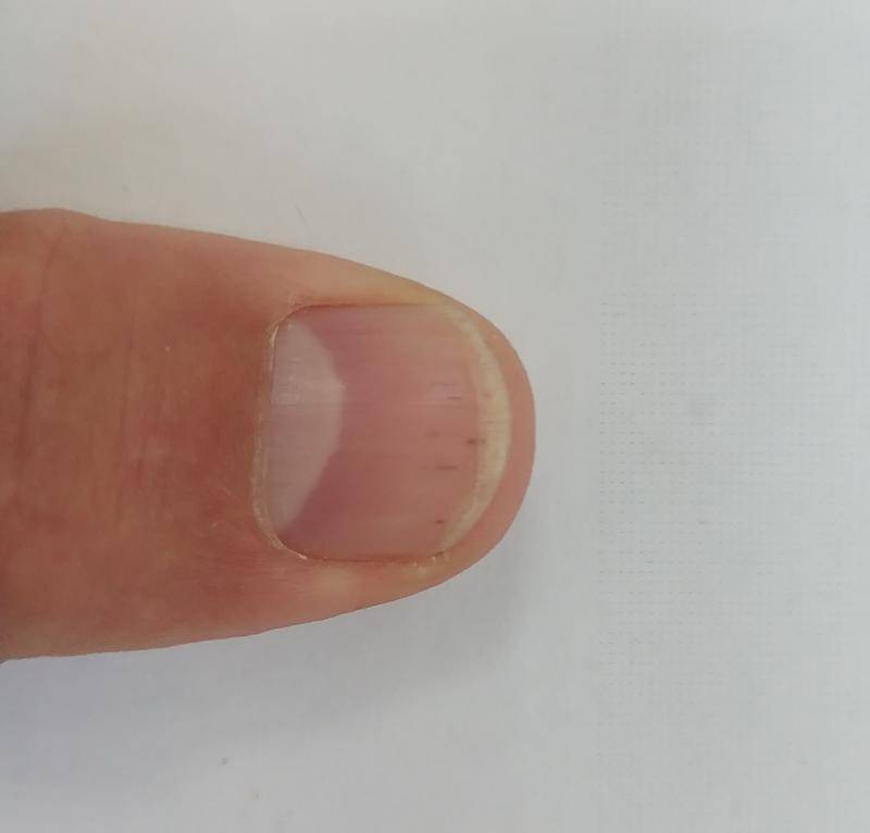 Лечение болезней и повреждений ногтей и кутикулы. о чём говорят деформации, ломкость и изменение цвета ногтей - медицинский центр «эхинацея»