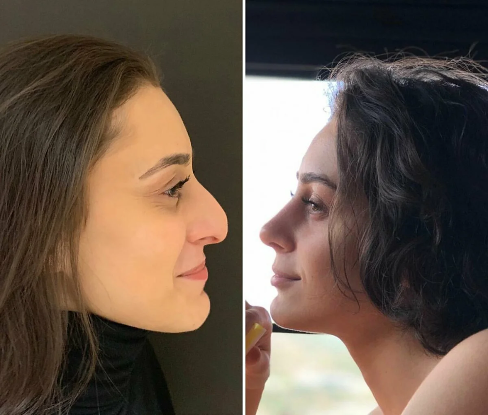 Пластика носа: фото до и после операции