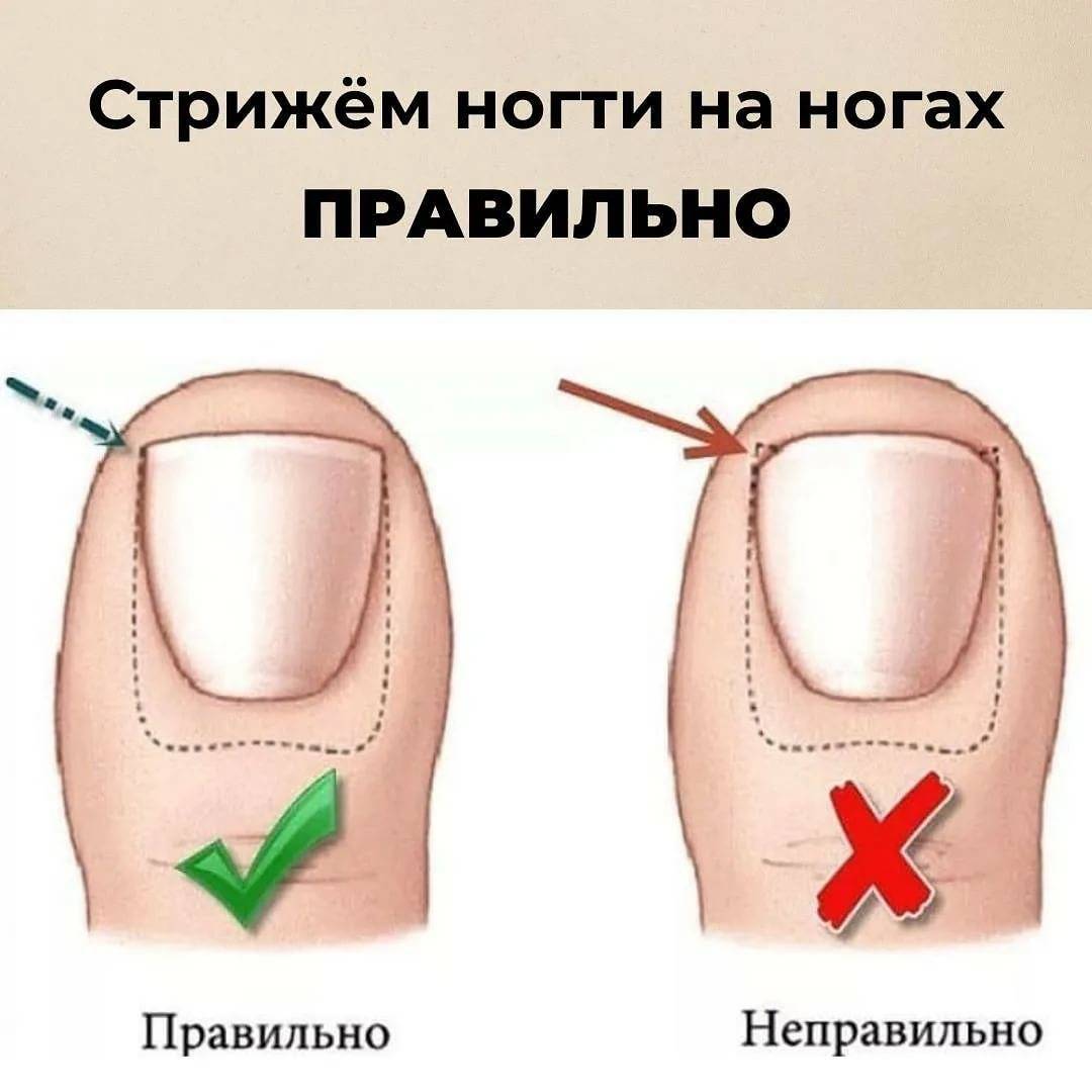 Как правильно стричь ногти на ногах, чтобы они не врастали | s-voi.ru
