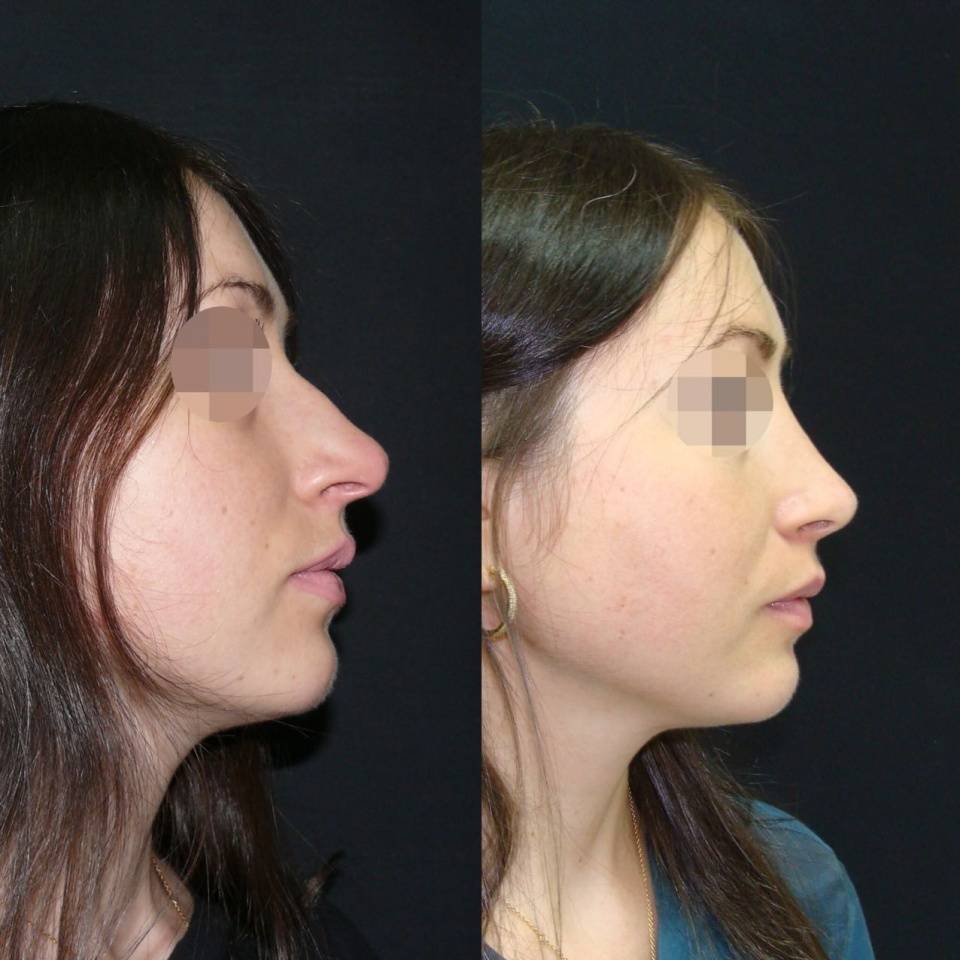 Ринопластика широкого носа: особенности операции | современный взгляд с давидом гришкяном на пластическую хирургию | дзен