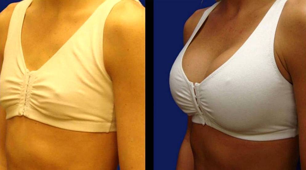 Маммопластика без имплантов: фото до и после, виды процедур, результаты, отзывы