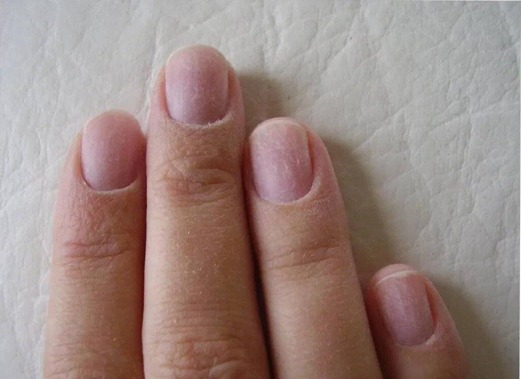 Как происходит восстановление ногтей после снятия нарощенных