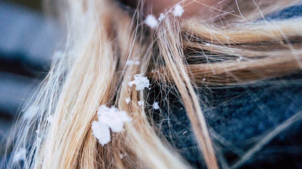 Выпадение волос зимой - причины сильного выпадения волос зимой
