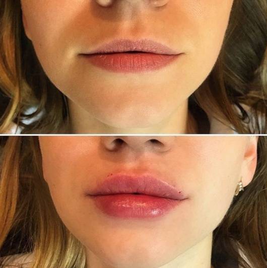 Можно или нет при помощи гиалуроновой кислоты приподнять уголки губ?
