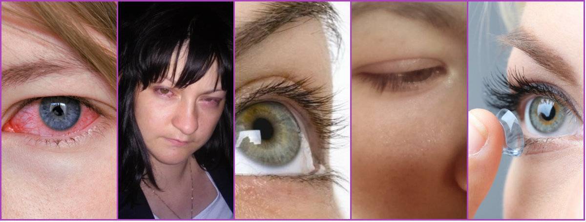 Покраснение глаз | частые заболевания, при которых краснеют глаза
