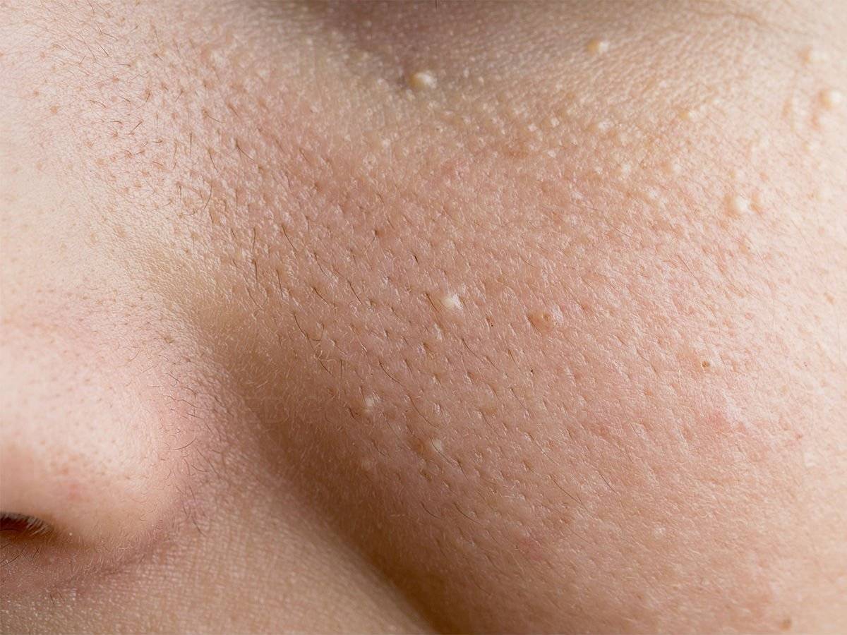 Как появляются рубцы от прыщей на лице и почему лазерная шлифовка не помогает убрать шрамы от прыщей