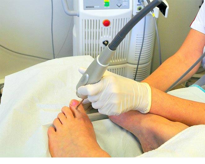 Лазерное лечение грибка ногтей на ногах: как лечить онихомикоз лазером? | mma-spb.ru