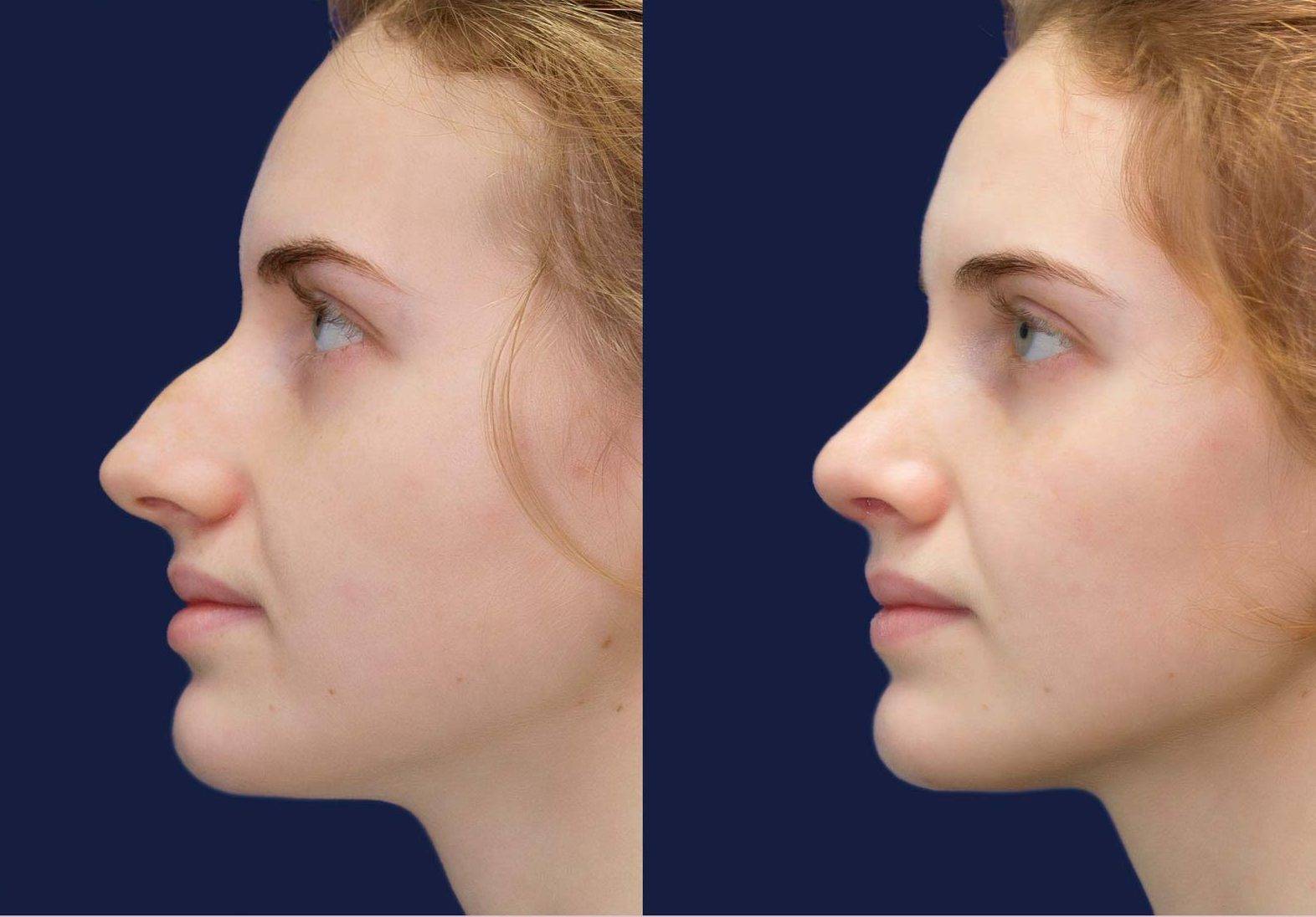 Курносый нос у девушки. фото, как это выглядит, как исправить, ринопластика, до и после операции