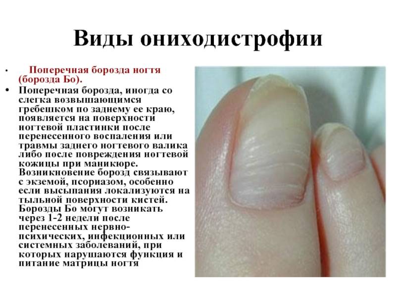 Черные темные пятна на ногтях – в чем причина появления?