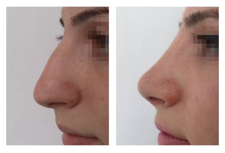 Увеличение носа филлерами фото до и после