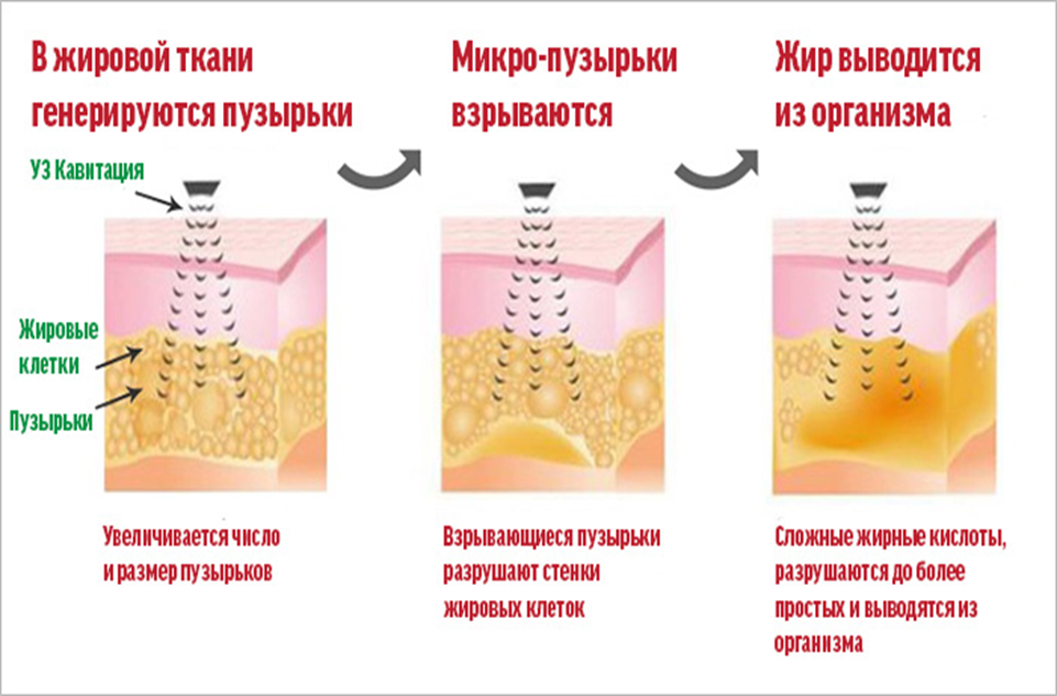 Ультразвуковая кавитация в клинике уро-про в краснодаре