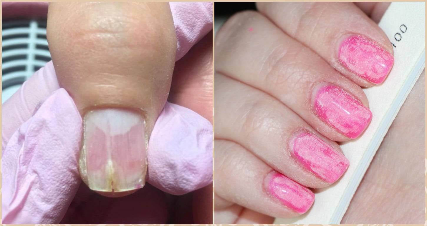 Как восстановить ногти после шеллака?