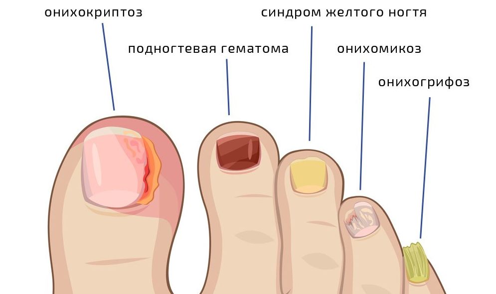 Травма ногтя спб. лечение травмы ногтя в ногтевой клинике