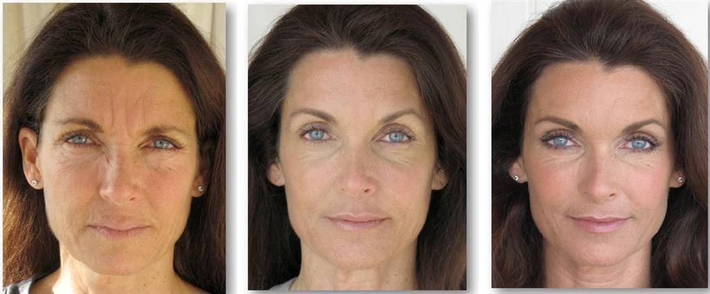 Плазмолифтинг лица: суть метода, отзывы, фото до и после