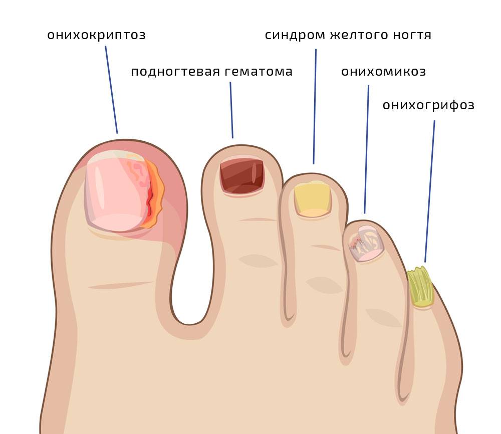 Причины желтых ногтей на ногах и на на большом пальце ноги
