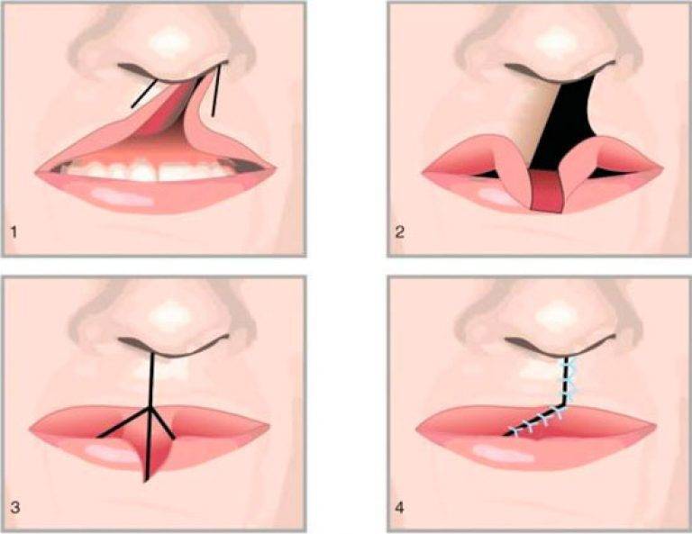 Можно или нет при помощи гиалуроновой кислоты приподнять уголки губ? - косметология доктора корчагиной
