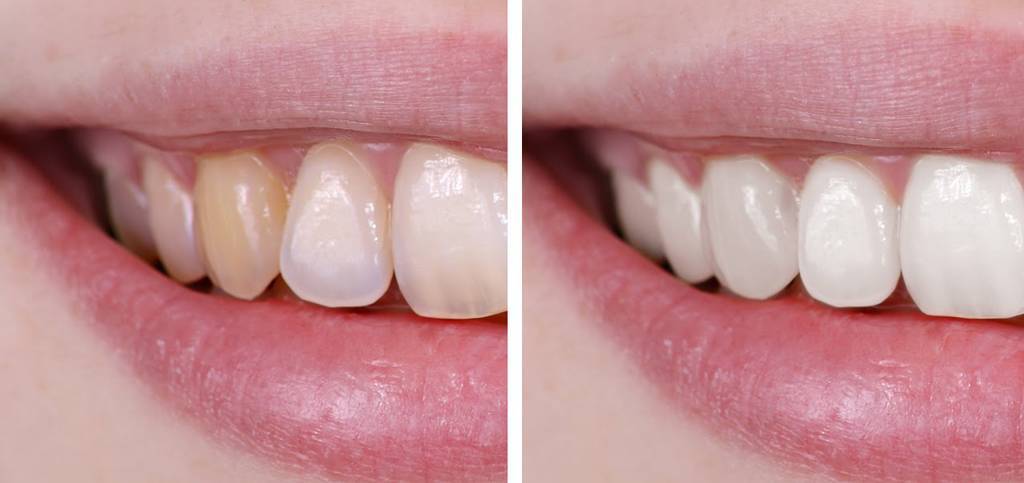 Процесс отбеливания зубов - как проходит отбеливание зубов