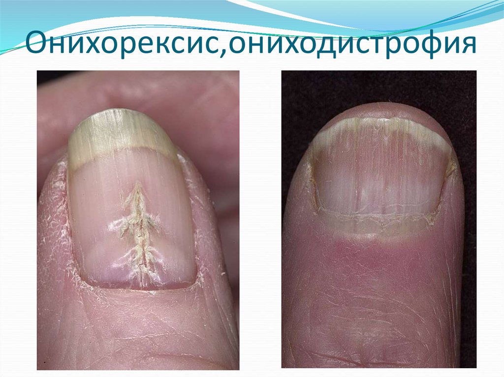 Дистрофия ногтевой пластины: виды, причины, рекомендации и методы лечения - sammedic.ru