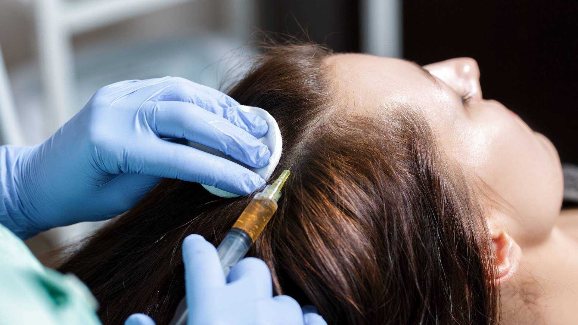 Плазмолифтинг – уколы красоты для волос и кожи головы