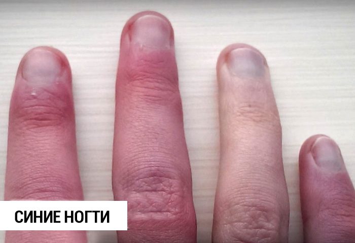 Почему ногти на руках и ногах желтеют и как с этим бороться? | блог маникюрного салона в москве