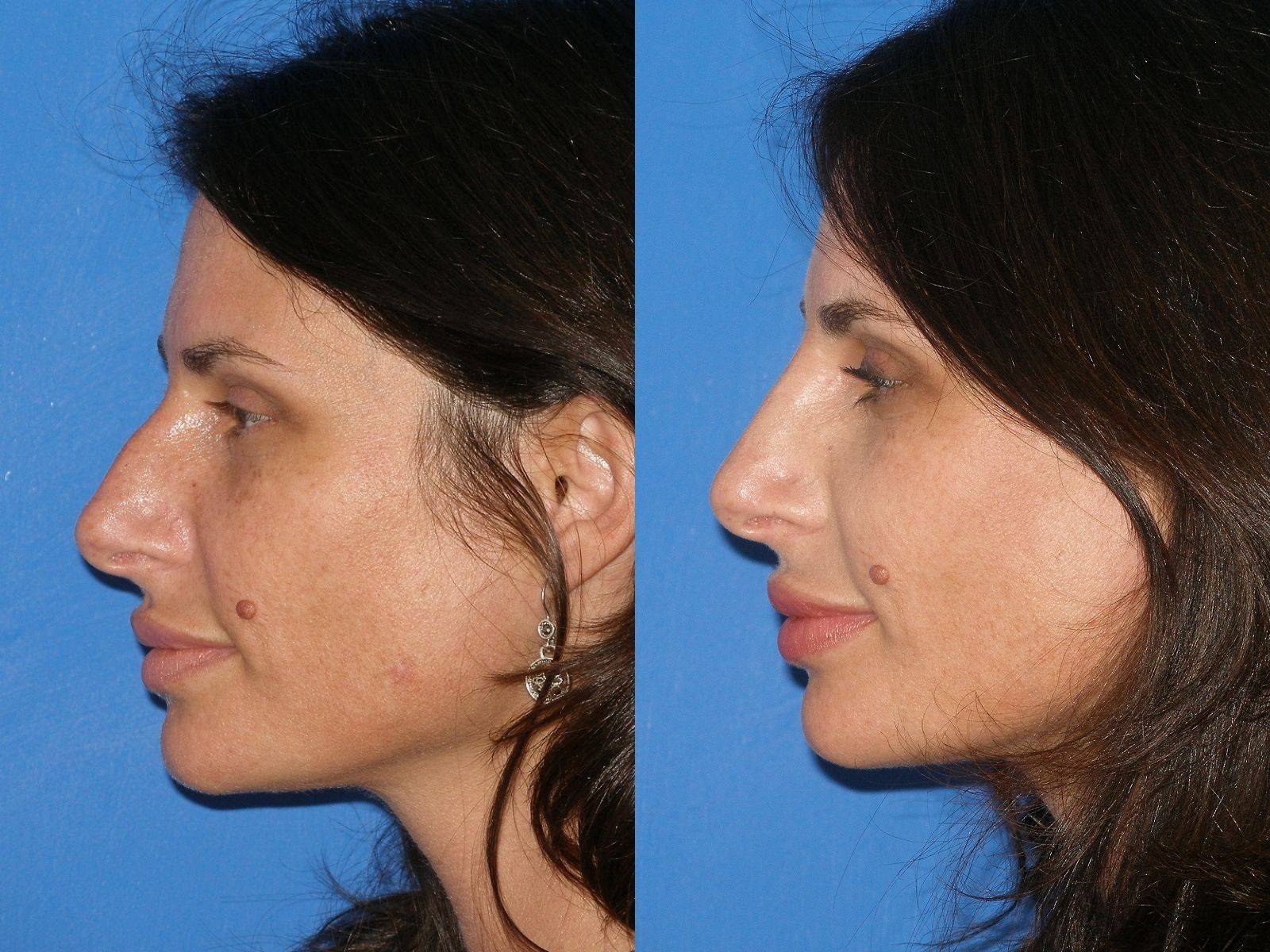 Курносый нос у девушки. как исправить, фото до и после ринопластики