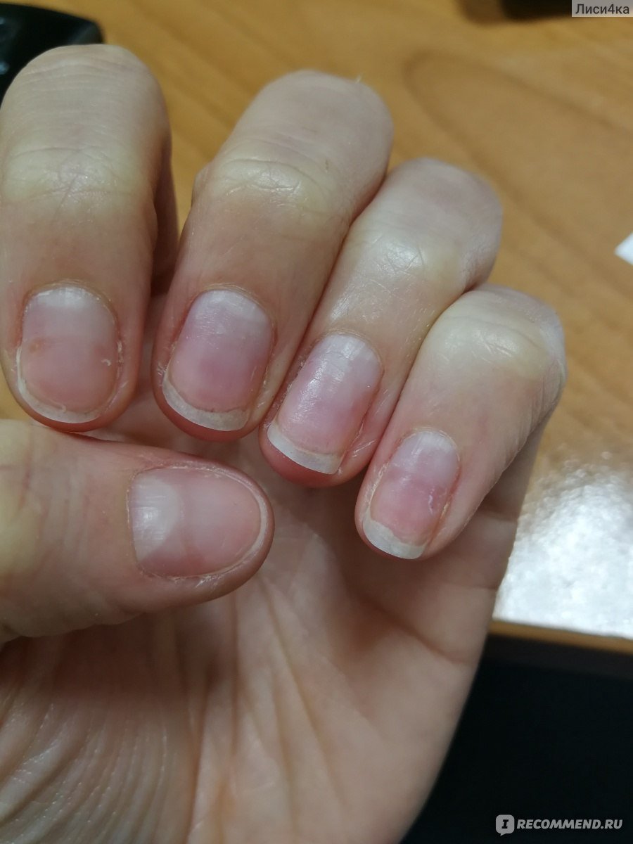 Восстановление ногтей после наращивания гелем или удаления