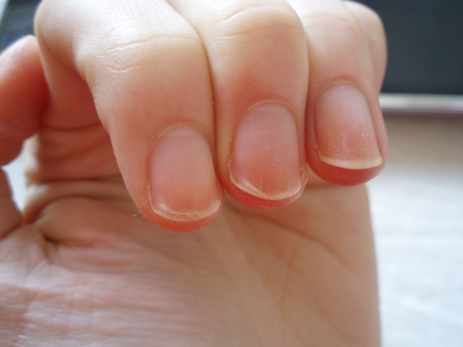 Слоятся ногти у ребенка - причины и лечение