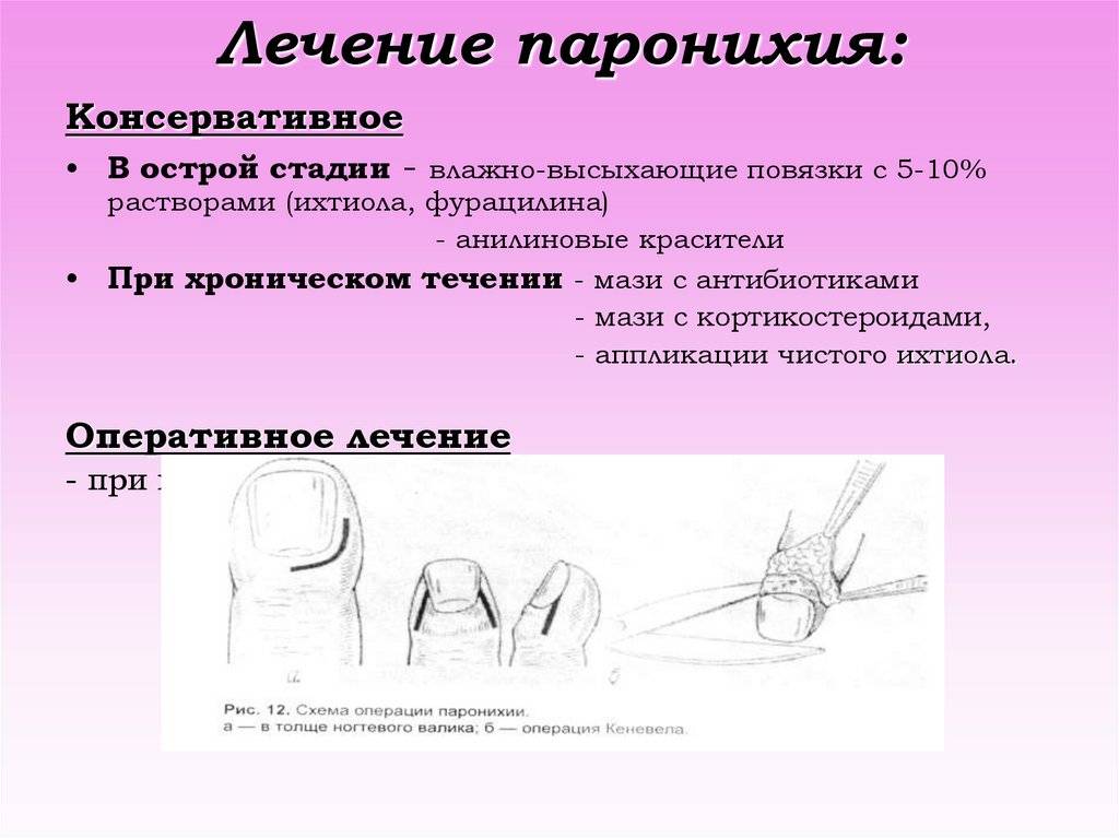 Панариций (гнойное воспаление тканей пальцев рук, ног) - мц биосс, медицинский центр клиника биосс: 1 мин - метро беговая, 10 мин