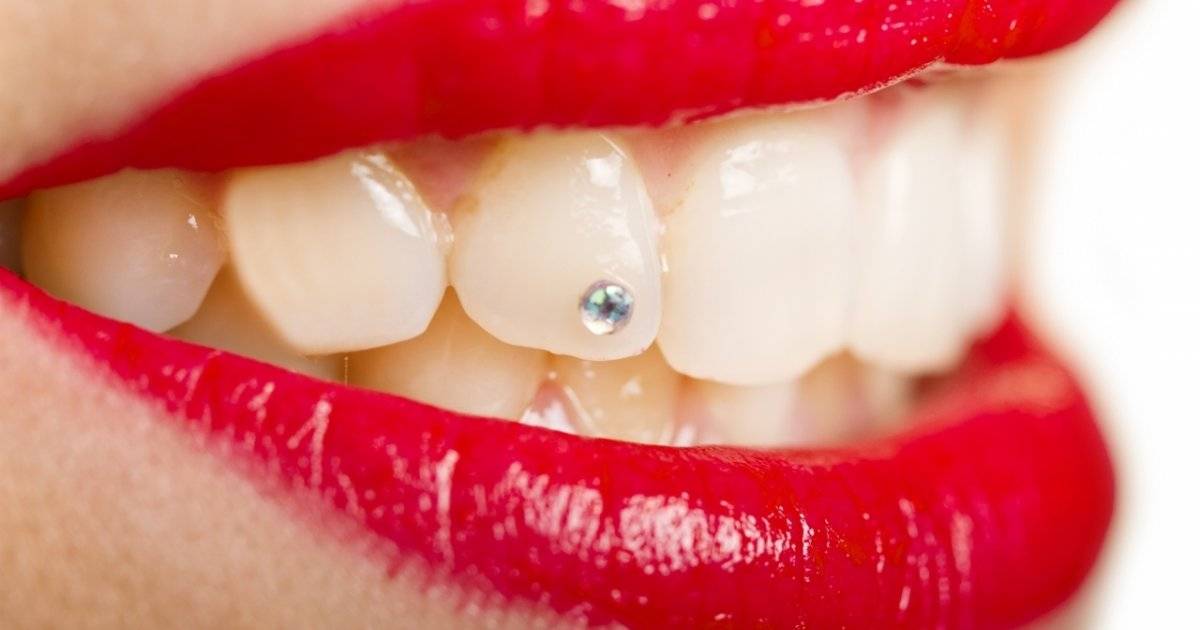 Какие бюгельные протезы для зубов лучше – сравнение видов | «фактор улыбки»