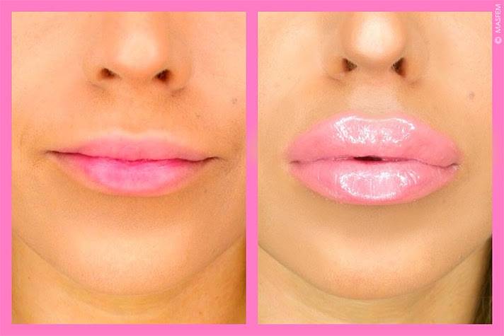 Как создать красивые губы | а клиника