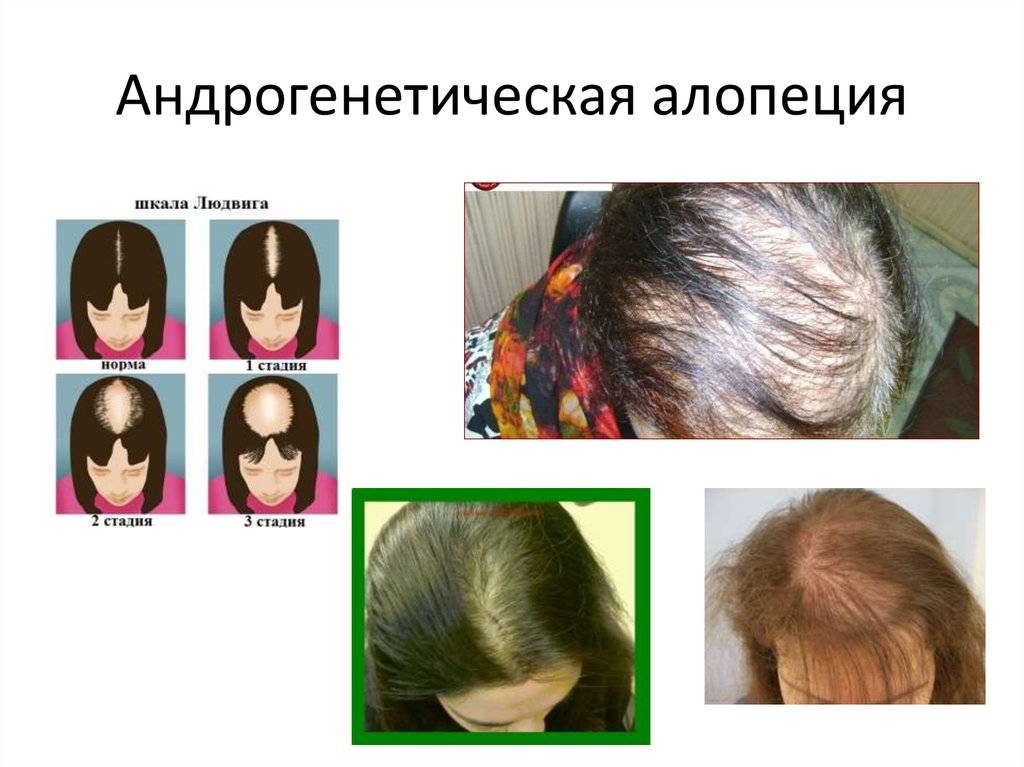 Диффузное выпадение волос: причины, лечение - клиника «доктор волос»