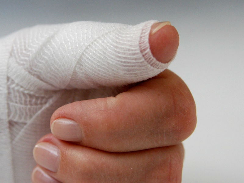 Повреждение сухожилий разгибателей пальцев и кисти