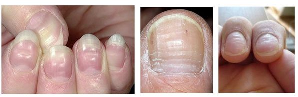 Причины деформации ногтей на руках - ногтевой сервис