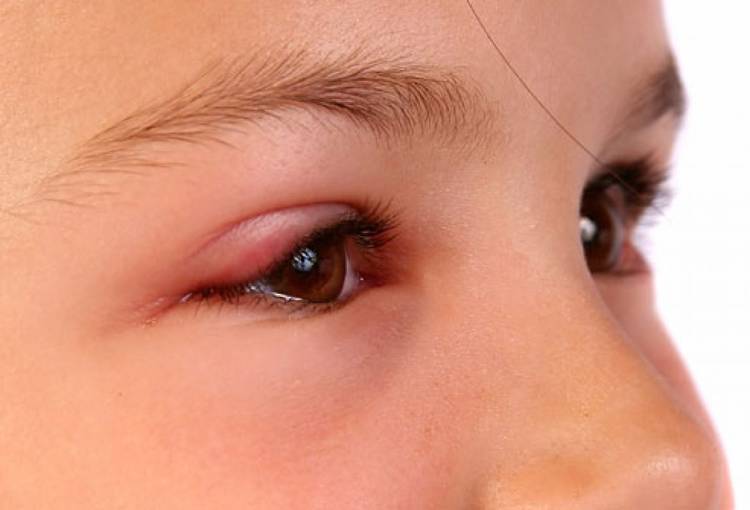 У ребенка красное под глазами: причины и что делать