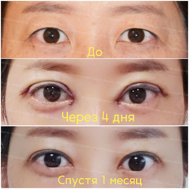 Endotine лифтинг – новая концепция омоложения