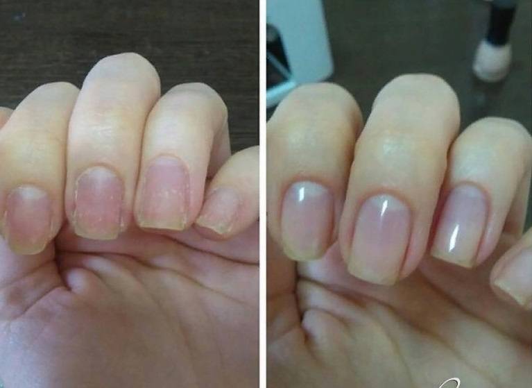Лучшие способы восстановления ногтей после наращивания