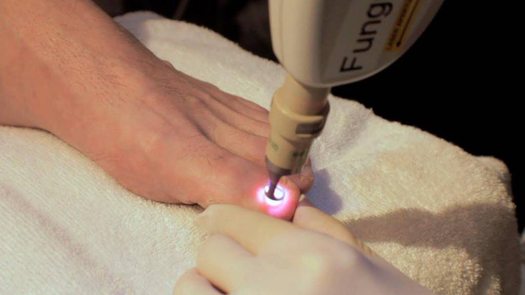 Лазерное лечение вросшего ногтя