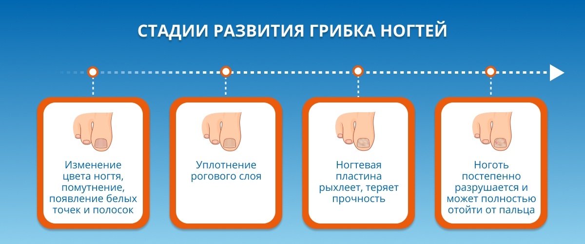 Лечение грибка ногтей: методы, особенности, описание процедуры и последствий