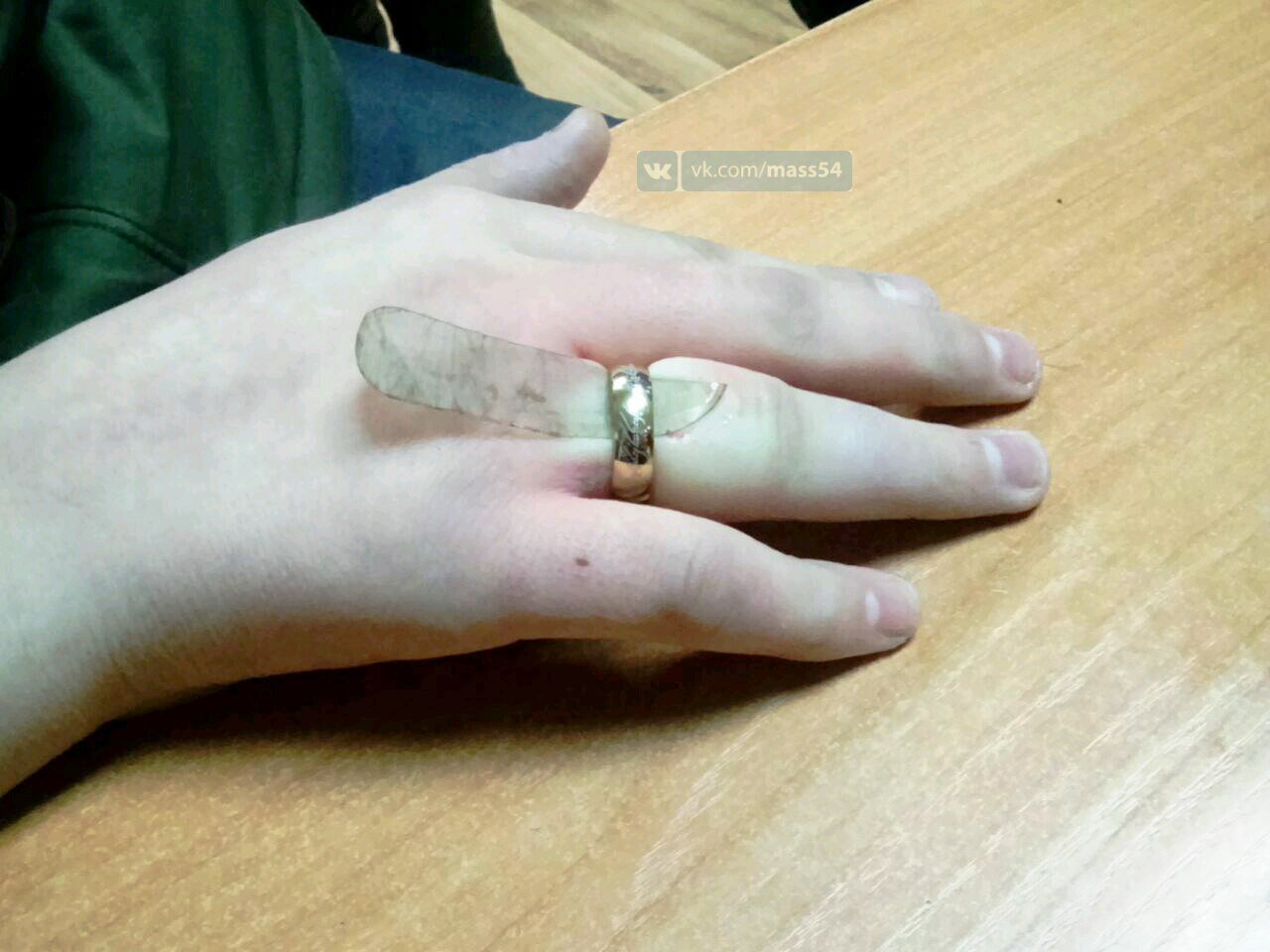 Снять кольцо с отекшего пальца