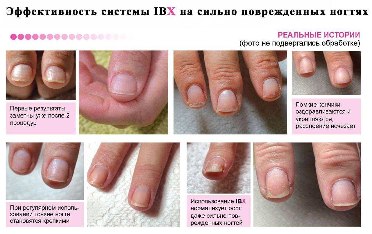 Как восстановить ногти после наращивания в домашних условиях - полезные советы