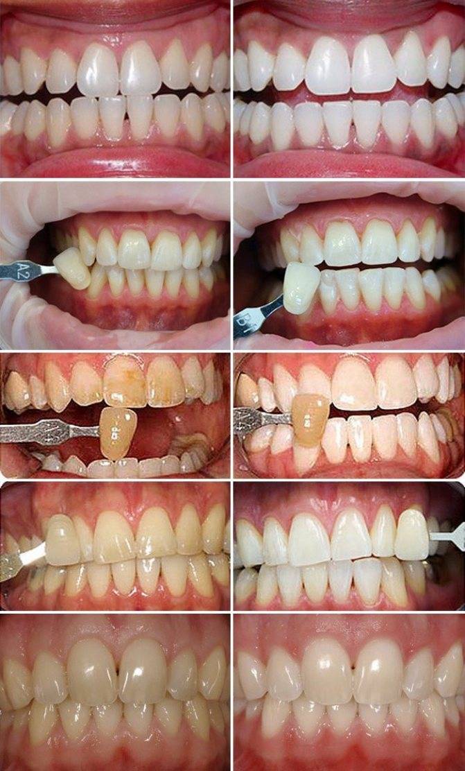 Перекись на зубы для отбеливания мягкая зубная щетка lacalut