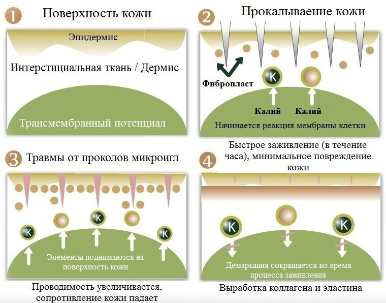 Фракционная мезотерапия кожи лица: особенности процедуры и её эффективность