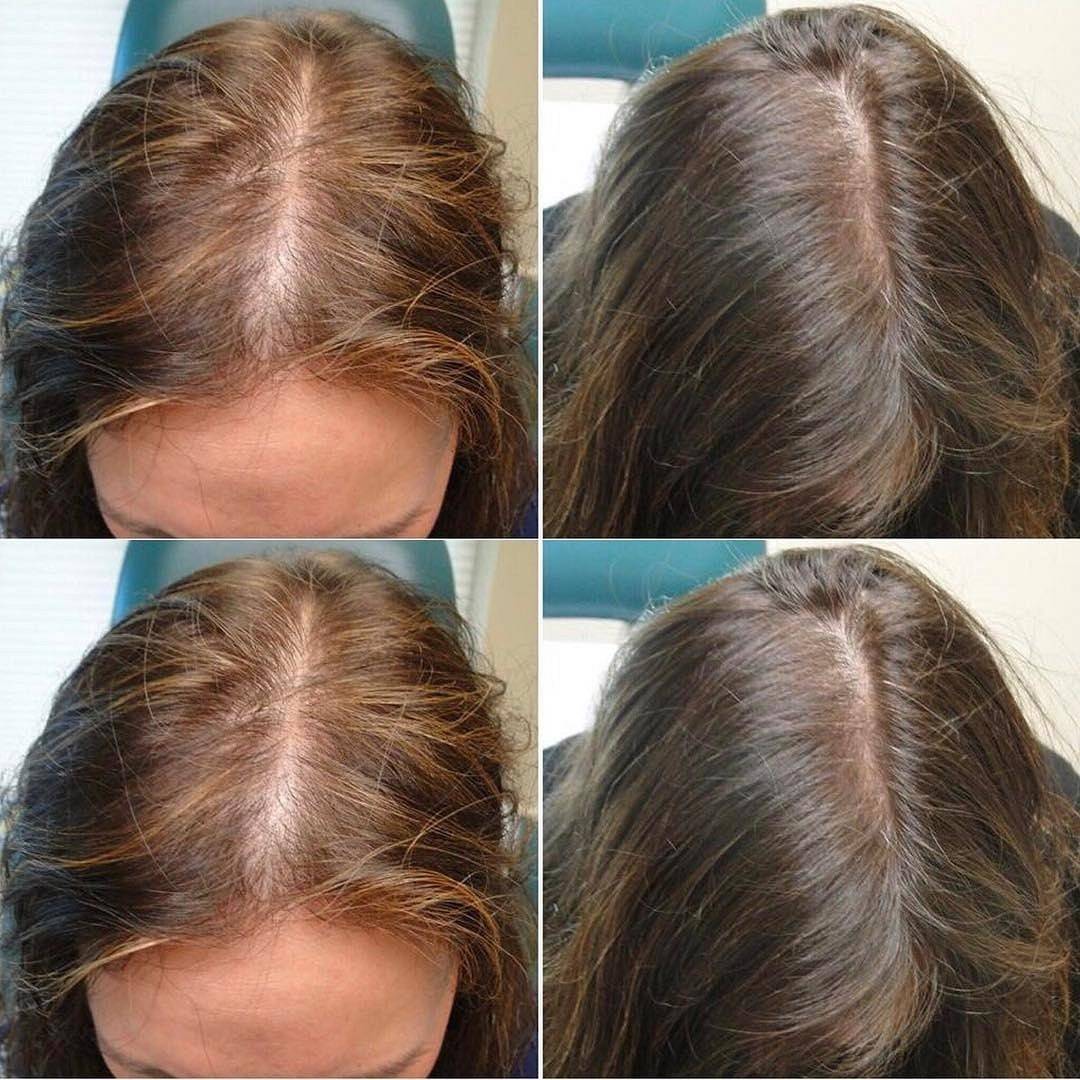 Плазмолифтинг волос фото до и после