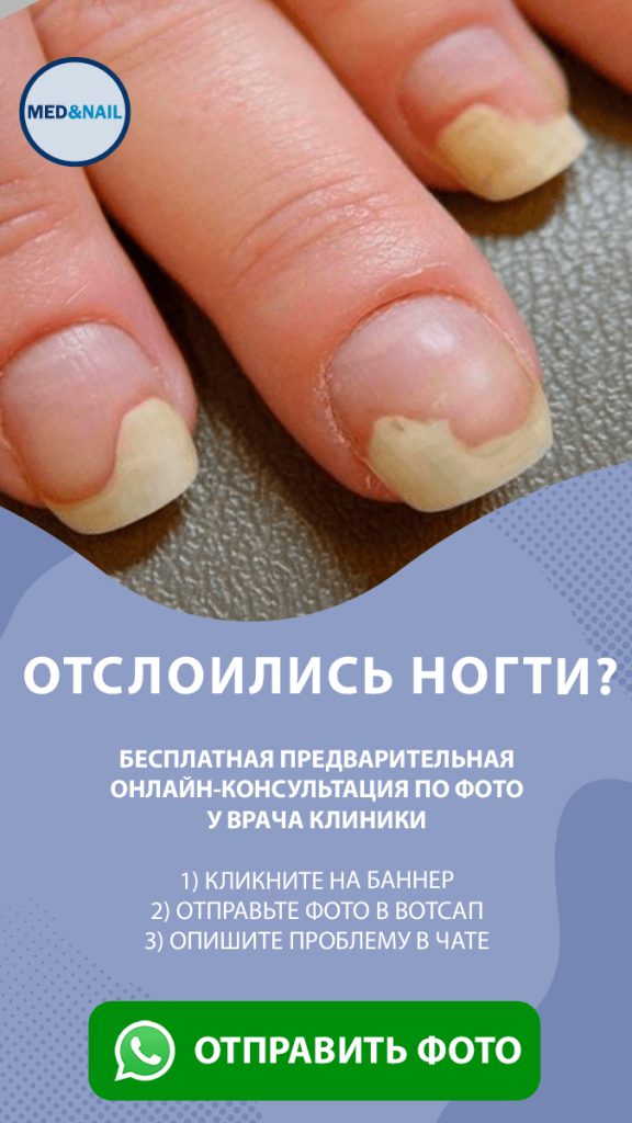 Травматичный онихолизис. Почему болят ногти под гелем