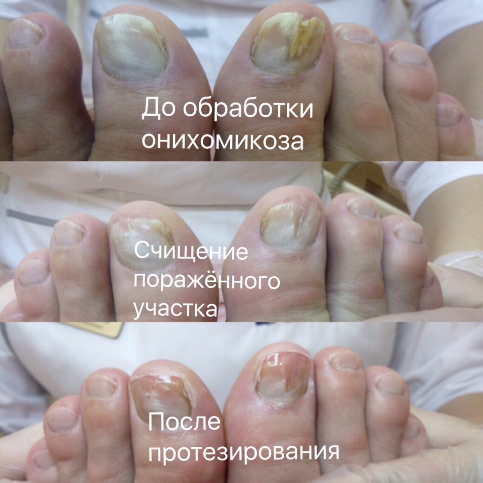 Деформация хаглунда