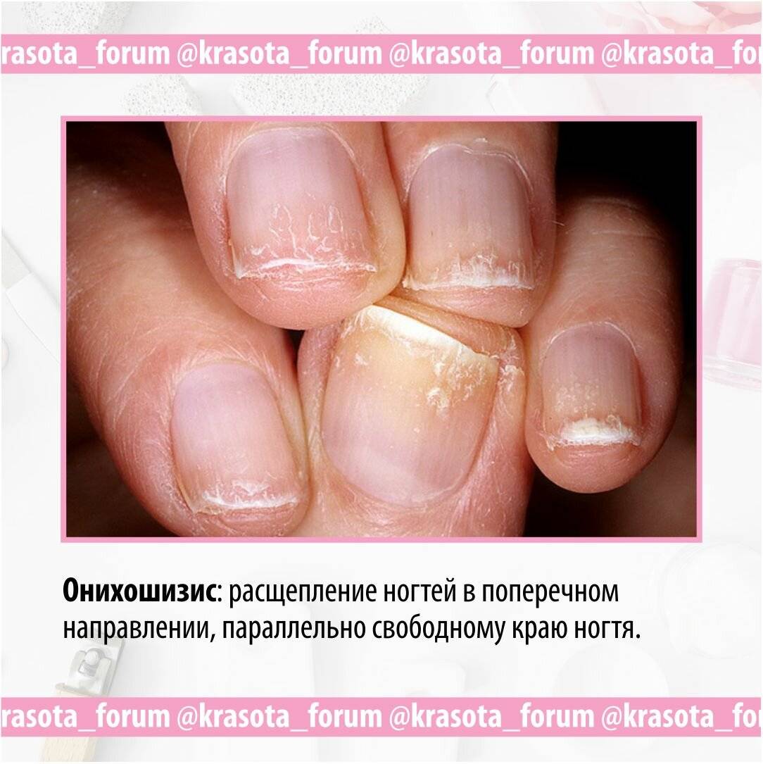 Продольные полосы на ногтях о чем говорят. Ониходистрофия - онихолизис..