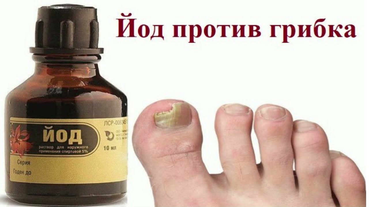 Йод от грибка ногтей на ногах: отзывы и рецепты для лечения в домашних условиях